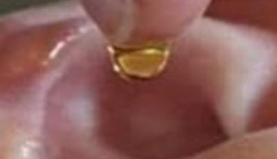 Put 2 drops in your ear and you will hear like before. Recover your hearing.