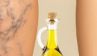 Grandmas Natural Remedy for Varicose Veins Aloe Vera Apple Cider Vinegar and Lemon