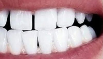 Remove Tartar and Whiten Your Teeth Naturally with Sage Leaves