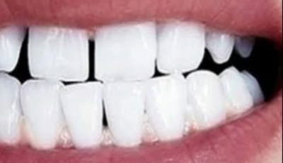 Remove Tartar and Whiten Your Teeth Naturally with Sage Leaves