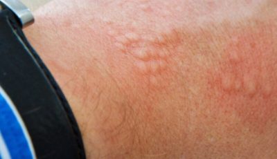 Signs of Groin Skin Irritation: Causes, Symptoms, and Gentle Care