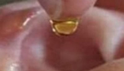 Put 2 drops in your ear and you will hear like before. Recover your hearing.
