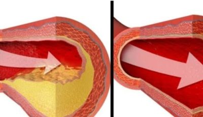 Only One Glass of This Juice…  Reverse Clogged Arteries Lower High Blood Pressure Naturally