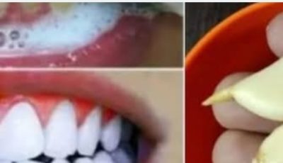 Teeth Whitening at Home in 2 Minutes: How to Naturally Whiten Yellow Teeth with Garlic and Baking Soda